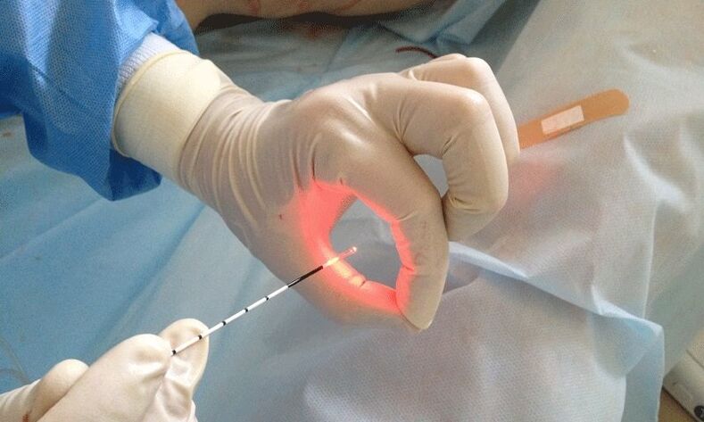 prostatitisaren laser tratamendua